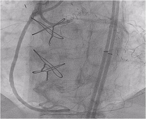 SVG RCA graft but a recurrence of symptoms prompted repeat angiography, revealing re-occlusion of the graft. She was then referred for PCI of her RCA CTO.