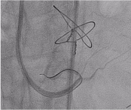 We were able to traversed the graft and into the distal RCA using a microcatheter and Pilot 200 wire.