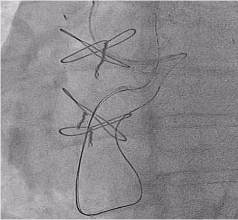 vessel. We then switched to a retrograde approach through the septal collaterals, which we were able to traverse using a Sion wire and microcatheter.