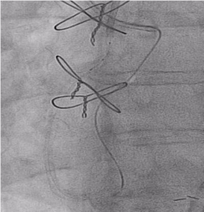Figure 5: Solving the Dilemma of Ostial Stenting in 73 years old man References 1. Kaluski E, Hendler A, Klapholz M.