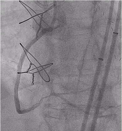 Dishmon DA, Elhaddi A, Packard K, Gupta V, Fischell TA. High incidence of inaccurate stent placement in the treatment of coronary aorto-ostial disease.