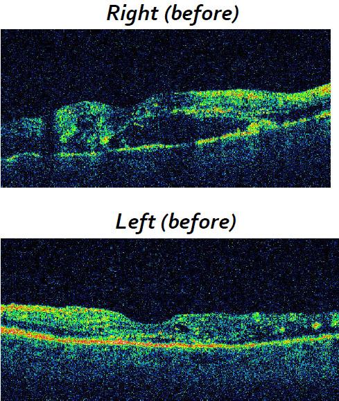 375 Figure 1: Red free photos showing evidence of PDR and DME in both eyes.