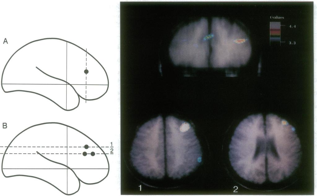 Neurobiology: Petrides et al. Proc. Natl. Acad. Sci. USA 90 (1993) 875 B 4_ W1-2 FIG. 2. Merged PET-MRI sections illustrating rcbf increases averaged for all nine subjects.