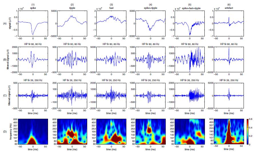 Overlap spikes/oscillations Benar et al 2010 Filtering sharp spikes or artefacts produces oscillations
