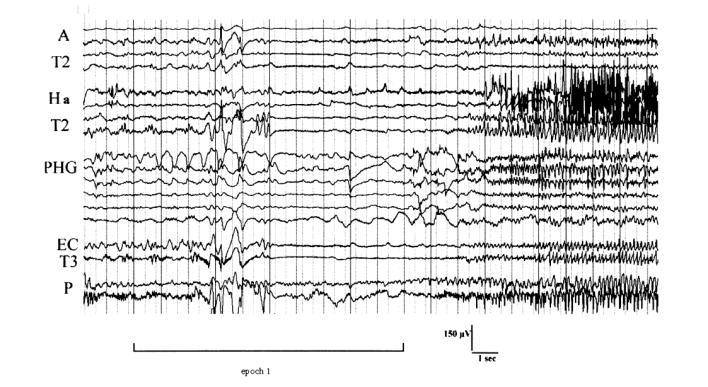 Why study MEG/EEG/SEEG epileptic networks?