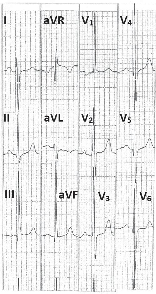 (a) (b) (a) (b) Figure 2 Electrocardiogram showing prominent R wave in lead V 1, right atrial overload (tall peaked P waves in leads II, avf and V 1 ) with tall R waves in leads V 2 to Figure 1