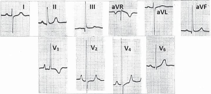 lead V 1 ), clockwise rotation and prominent qr in leads V 4 and V 5 (Figure 2,3) Tall R in right precordial loads R/S ratio greater than 15 (Figure 1, 2,3) Caution- Asthenic individuals may have LVH