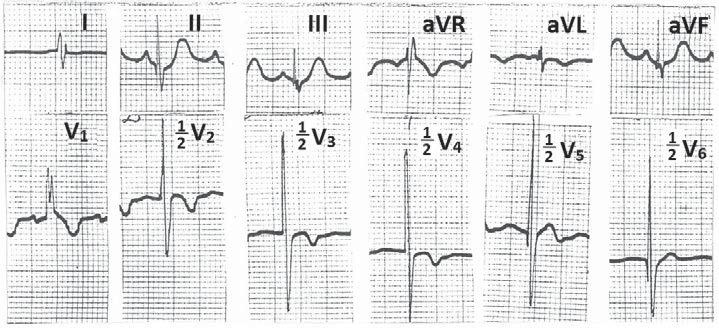 Figure 5 Electrocardiogram from case of Ventricular septal defect (VSD) with pulmonary artery hypertension showing incomplete RBBB with tall RS (>60 mm) in leads V 3 to V 5 (Katz- Wachtel sign)