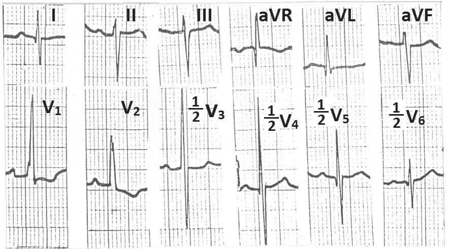 pulmonary artery hypertension showing SISIISIII, counter clockwise loop (q in I and avl), prominent R in lead V 1 with tall RS in lead V 3 (70 mm) and V 4 (80 mm) (Katz Wachtel sign) Figure 9
