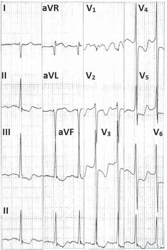 showing right axis deviation, prominent R in lead V 1 and qr in leads V 5 - RS in V 1 and very deep S in V 2 2,6 (Figure 8, 9) or - Prominent R with ST-depression in lead V 5 suggestive of LVH