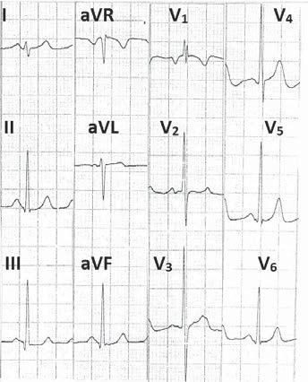 Tall R in right as well as left precordial leads 4 These criteria are less specific but more sensitive Figure 10 Electrocardiogram showing P-Pulmonale (tall peaked P waves in V 2, V 3 ), qr
