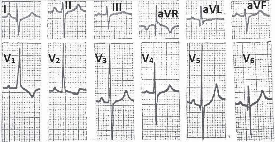of P wave in lead V 1 ) 1 Mirvis DM, Goldberger AL Electrocardiography In Mann DL, Zipes DP, Libby P, Bonow RO (eds) Braunwald s Heart Disease Elsevier, Philadelphia; 2015:114-152 2 De luna AB,