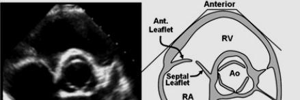 Parasternal short axis of basal RV Utility: Assessment of basal anterior RV wall, RVOT, TV, PV and RA Measurement of