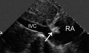 coronary sinus Visible fetal remnants- Eustachian
