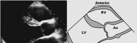 Parasternal long axis view of RV anterior wall Measurement of: RV enlargement RV wall thickness RV OT dimension Caveats: 1.