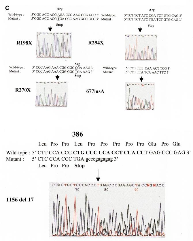 Human Molecular Genetics, 2000, Vol. 9, No. 9 1379 Figure 1. (A) DGGE results corresponding to the fragment 3A of the MECP2 gene. Lane 1, T158M; lanes 2 4, normal; lane 5, R168X.
