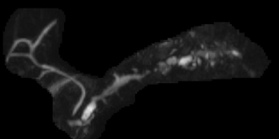 Chronic Pancreatitis Role of MR/MRCP Imaging features Tissue loss, atrophy PD dilatation