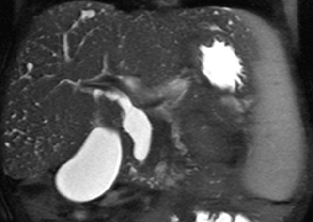 5 year old girl with known congenital hepatic fibrosis- stricture of CBD GB S Coronal HASTE image