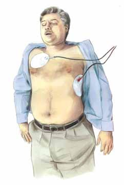Electrical Therapies Practice needed to minimize interruption in chest compressions to deliver shock.