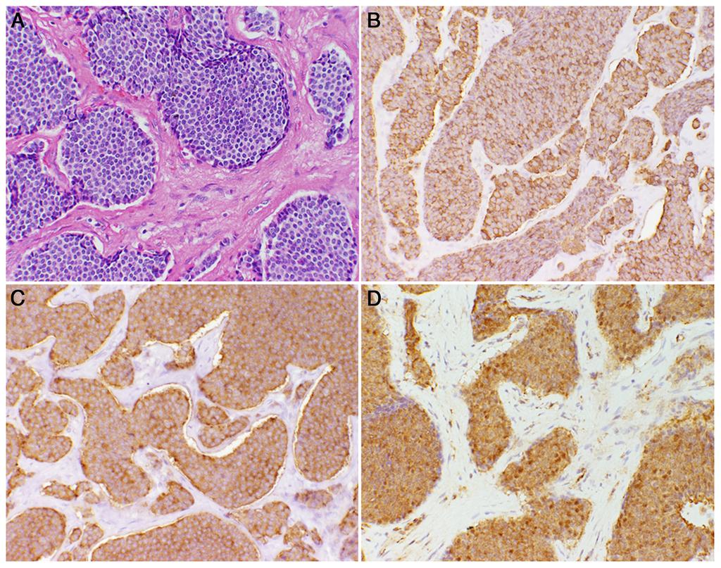 doi: 10.1210/jc.2015-3684 press.endocrine.org/journal/jcem 355 Figure 2. Tumor immunohistochemistry. A, Hematoxylin and eosin-stained section of pancreatic NET (20 magnification).