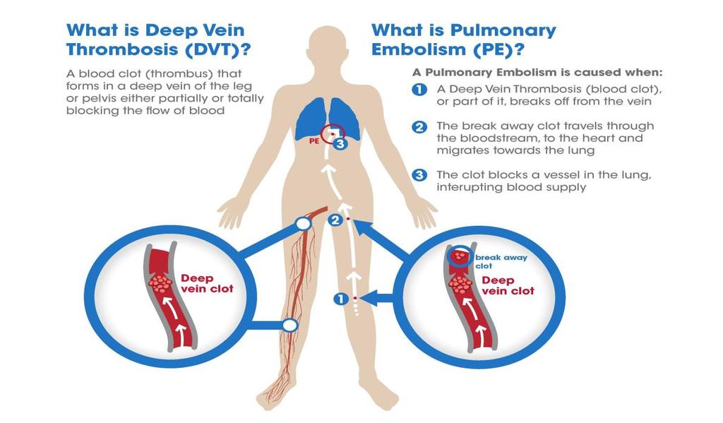 Deep Vein Thrombosis and Pulmonary Embolism DVT: often in the legs, veins of the arms, the splanchnic veins, and cerebral veins