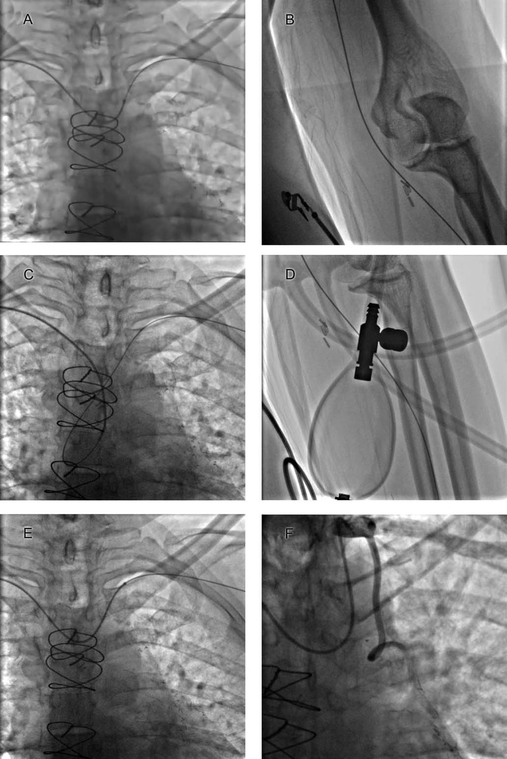LIMA Cannulation Through Right TRA 317 Fig. 1. A and B: Cannulation of origin of left subclavian artery using a 5F Optitorque TIG diagnostic catheter (Terumo, Japan) and advancement of a 0.