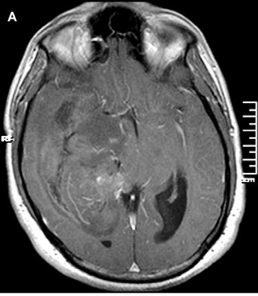 shows non-enhancing tumor in the right cerebral