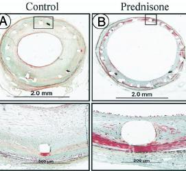 Corticosteroids: Effect on Atherosclerosis Corticosteroids exhibit an anti-inflammatory