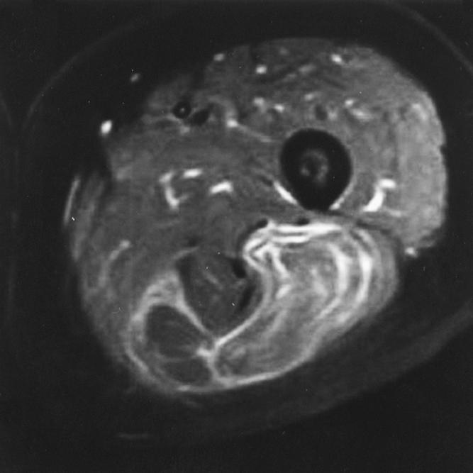 Completely irregular margins were recognized only in benign lipomas with a pathologic diagnosis of infiltrating lipoma (Fig. 2).