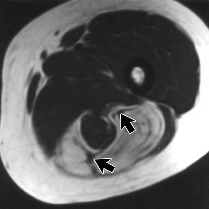 tissue. In the remaining intramuscular lipoma, the margin was partially irregular. The assessment of internal characteristics showed that all the type I tumors were benign lipomas (Fig. 3).