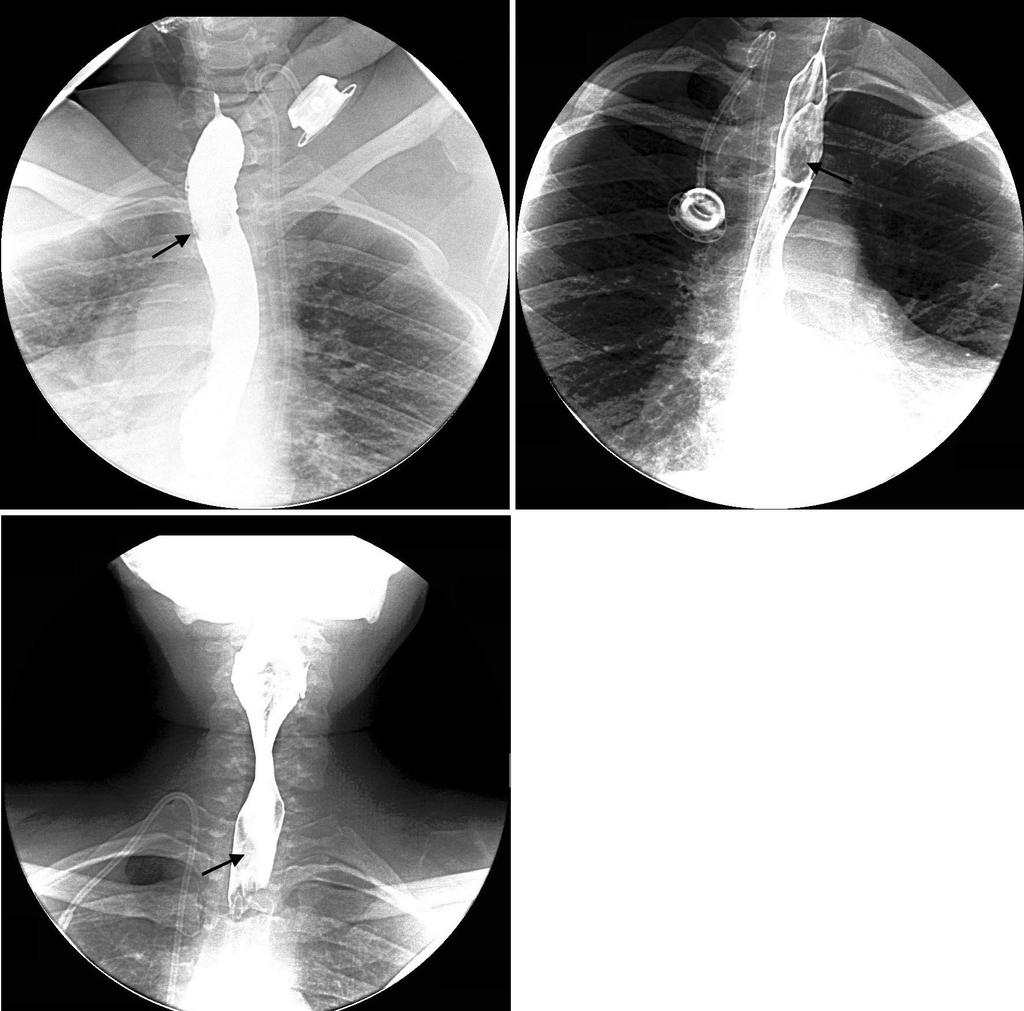 FIGURES Figure 1: 53-year-old African American female with dysphagia who presented for a double contrast esophagram was found to have an esophageal lipoma.
