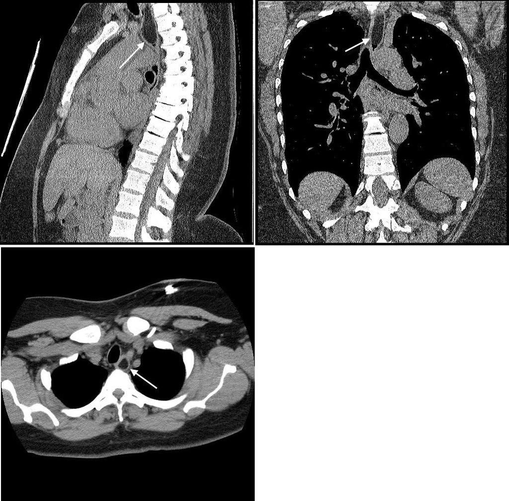 Figure 2: 53 year old African American female presents for evaluation of a left lower lobe pulmonary nodule was found to have an esophageal lipoma.