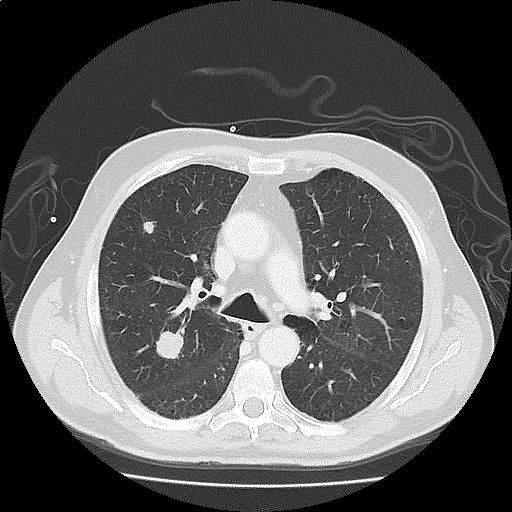 Separate tumour nodules One typical solid lung cancer One or more separate solid nodules with similar CT features,