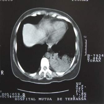 Pneumonic type adenocarcinomas Single