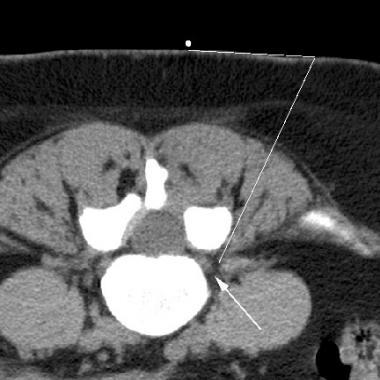 CT scan from a scout series prior to a lumbar nerve root block. Note the marker, which allows accurate measurements to determine the optimal site for skin puncture (lines).