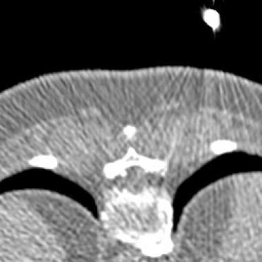 CT fluoroscopic image from a thoracic nerve root block study demonstrates the needle tip in the outer aspect of the neural foramen.