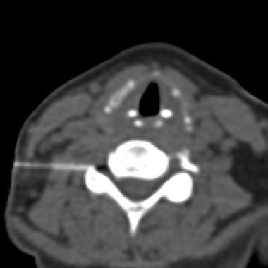 CT fluoroscopic image from a cervical nerve root block demonstrates the appropriate needle path and the placement of the needle tip in the lower aspect of the neural foramen.