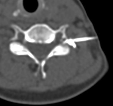 The injection of a small amount of contrast material under the guidance of a few seconds of CT fluoroscopy can be used to confirm the extravascular location of the needle.