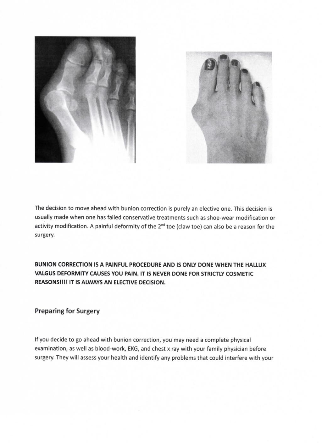 The decision to move ahead with bunion correction is purely an elective one.