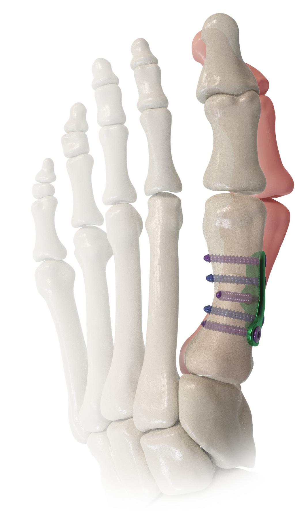 A i Line Proximal Bunion Correction System TM Desired angle
