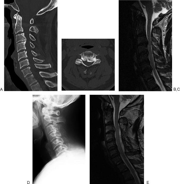 Ito, Nagahama 191 Figure 4 (A) A preoperative sagittal computed tomography (CT) image of the cervical spine of a 62-year-old man shows cervical ossification of the posterior longitudinal ligament