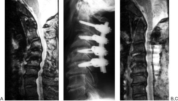 192 Ito, Nagahama Figure 5 (A) Kyphosis correction for patients with cervical myelopathy and kyphotic deformity.