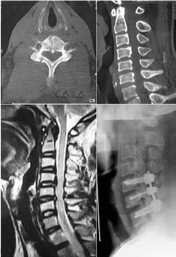 A b c d Figure 2: A 40-year-old male experienced acute fracture of the C6 vertebrae without displacement (A) and OPLL of C4 (B) with multiple segment compression, cervical spinal cord edema (C), and