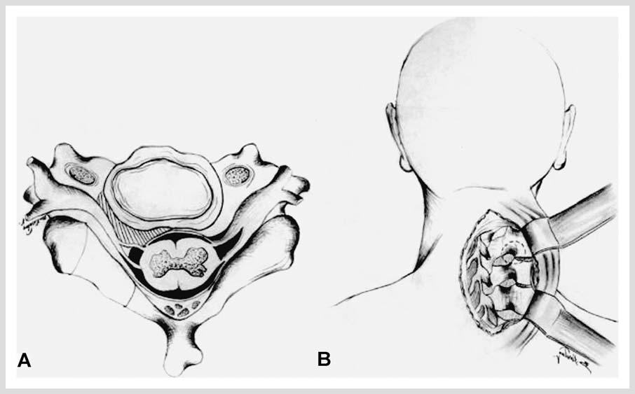 8 Original Article Fig. 1 A Illustration of a posterolaterally located soft disc herniation. B Illustration of the approach. Fig. 2 A Illustration of drilling of the medial facet joint and lamina.