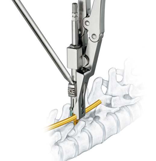 Optional Method for Assembling the Construct continued 2 Engage rod 388.410 Distraction Forceps, curved (for 6.0 mm rods) 388.
