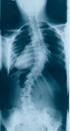 Universal Spinal System Goals of Scoliosis Surgery Correct sagittal and coronal alignment Restore balance in the spine Prevent further progression of deformity Fuse the fewest number of vertebral
