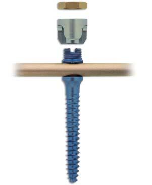 The system is based upon: Independent anchorage of hooks and/or screws to the spine and independent rod positioning Simple connection between the implant and the rod Segmental correction and