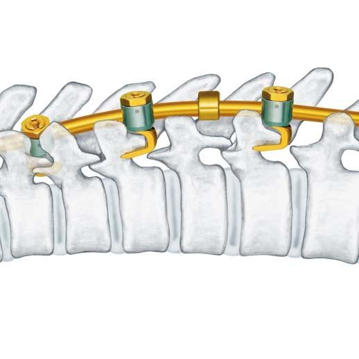 Indications Posterior Components The Synthes Universal Spinal System (USS) devices are noncervical spinal fixation devices intended for use as posterior pedicle screw fixation systems (T1 S2), a