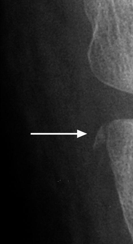 D, Sagittal reformation of T scan shows avulsion fracture fragments (black arrows) of proximal attachment of posterior cruciate ligament.