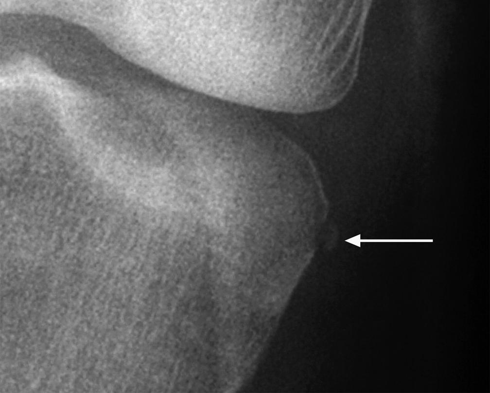 The medial tibial fragment seen on radiographs was noted retrospectively, as were both a small adjacent cortical defect and a peripheral tear of the medial meniscus (Fig. 2).